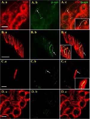 Optimization of the Detection Method for Phosphorylated α-Synuclein in Parkinson Disease by Skin Biopsy